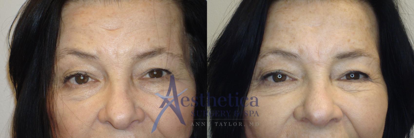 Blepharoplasty (Eyelid Surgery) Case 789 Before & After Front | Columbus, OH | Aesthetica Surgery & Spa