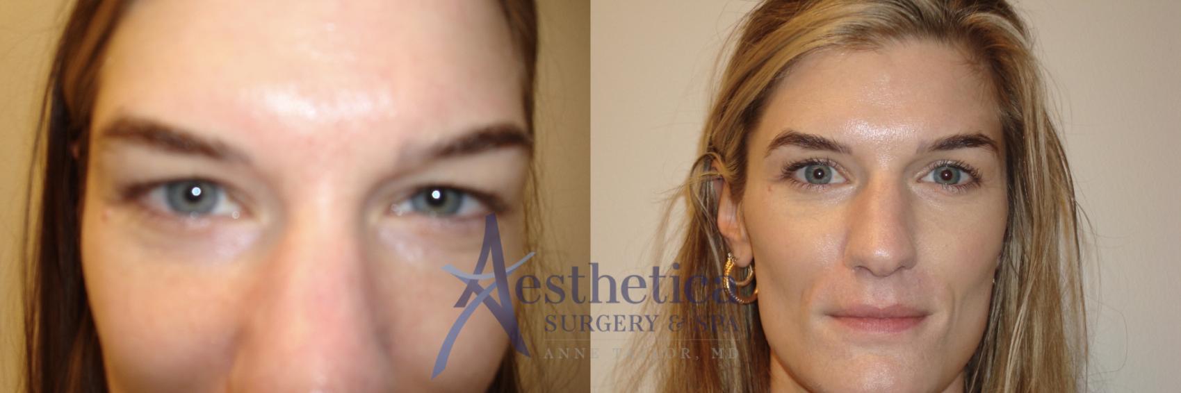 Blepharoplasty (Eyelid Surgery) Case 805 Before & After Front | Columbus, OH | Aesthetica Surgery & Spa