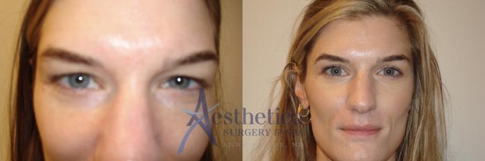 Blepharoplasty (Eyelid Surgery) Case 805 Before & After Front | Columbus, OH | Aesthetica Surgery & Spa