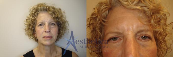 Blepharoplasty (Eyelid Surgery) Case 808 Before & After Front | Columbus, OH | Aesthetica Surgery & Spa