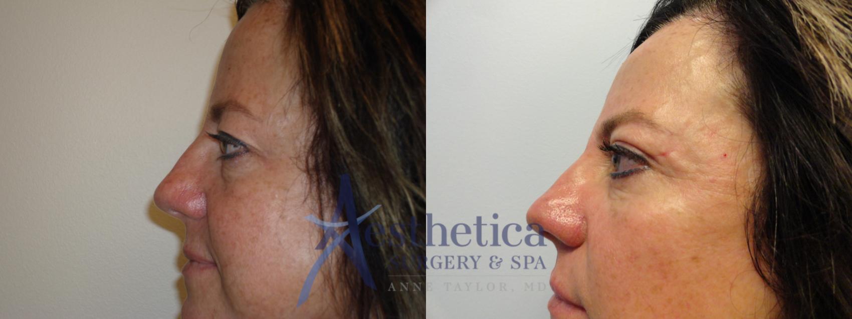 Blepharoplasty (Eyelid Surgery) Case 816 Before & After Left Side | Columbus, OH | Aesthetica Surgery & Spa