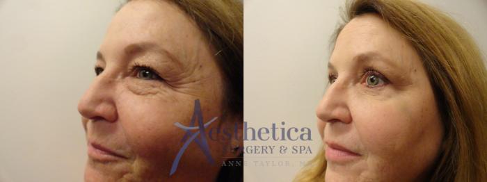 Blepharoplasty (Eyelid Surgery) Case 828 Before & After Left Side | Columbus, OH | Aesthetica Surgery & Spa