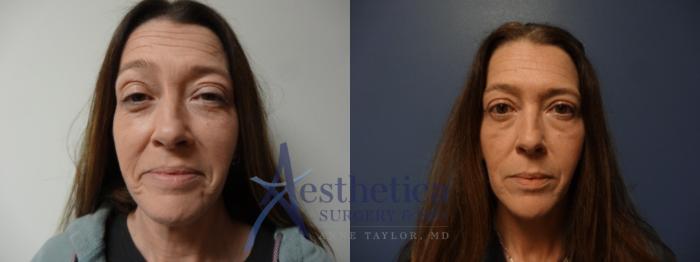 Blepharoplasty (Eyelid Surgery) Case 878 Before & After Front | Columbus, OH | Aesthetica Surgery & Spa