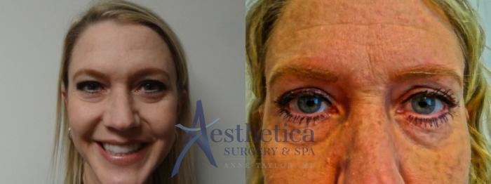 Blepharoplasty (Eyelid Surgery) Case 886 Before & After Front | Columbus, OH | Aesthetica Surgery & Spa