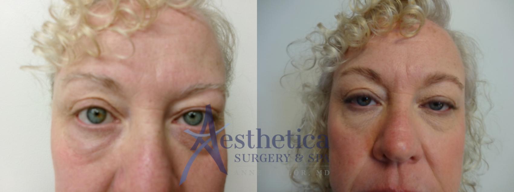 Blepharoplasty (Eyelid Surgery) Case 906 Before & After Front | Columbus, OH | Aesthetica Surgery & Spa