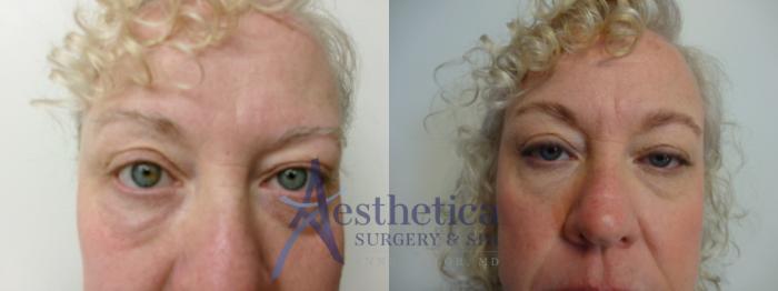 Blepharoplasty (Eyelid Surgery) Case 906 Before & After Front | Columbus, OH | Aesthetica Surgery & Spa