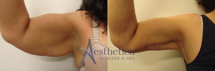 Brachioplasty Case 311 Before & After View #1 | Columbus, OH | Aesthetica Surgery & Spa