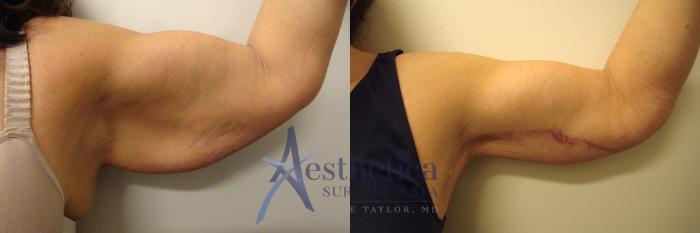 Brachioplasty Case 311 Before & After View #2 | Columbus, OH | Aesthetica Surgery & Spa