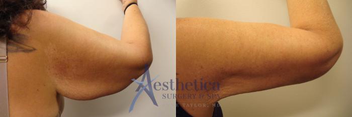 Brachioplasty Case 311 Before & After View #3 | Columbus, OH | Aesthetica Surgery & Spa