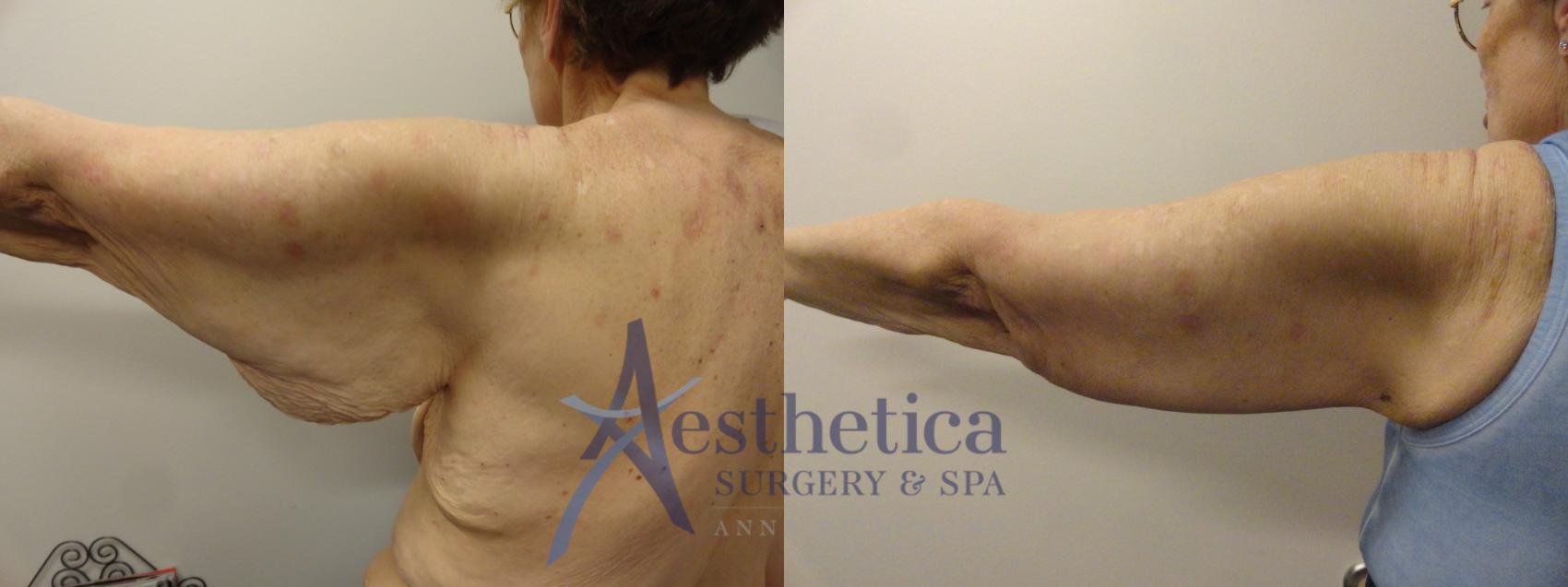 Brachioplasty Case 326 Before & After View #1 | Worthington, OH | Aesthetica Surgery & Spa
