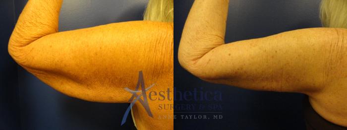 Brachioplasty Case 339 Before & After View #1 | Columbus, OH | Aesthetica Surgery & Spa