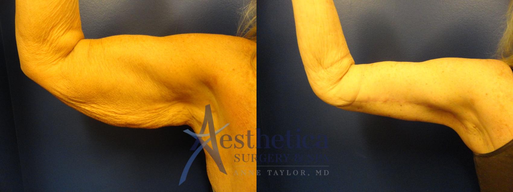 Brachioplasty Case 339 Before & After View #2 | Columbus, OH | Aesthetica Surgery & Spa