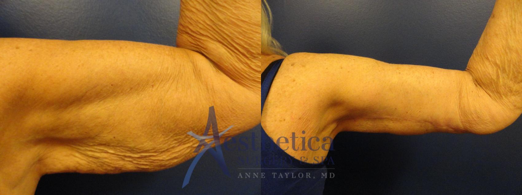 Brachioplasty Case 339 Before & After View #3 | Columbus, OH | Aesthetica Surgery & Spa