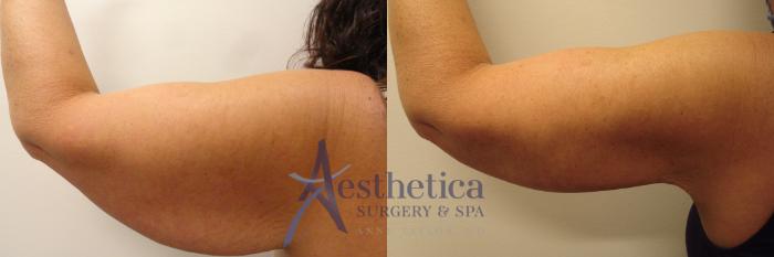 Brachioplasty Case 356 Before & After View #1 | Columbus, OH | Aesthetica Surgery & Spa