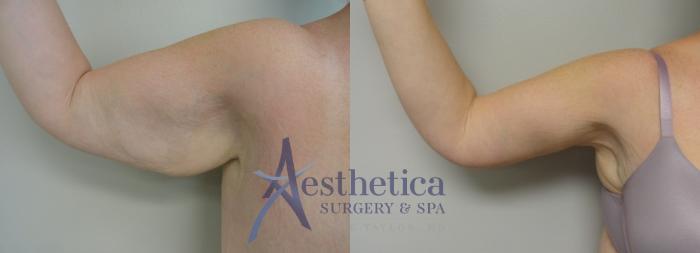 Brachioplasty Case 50 Before & After View #2 | Columbus, OH | Aesthetica Surgery & Spa