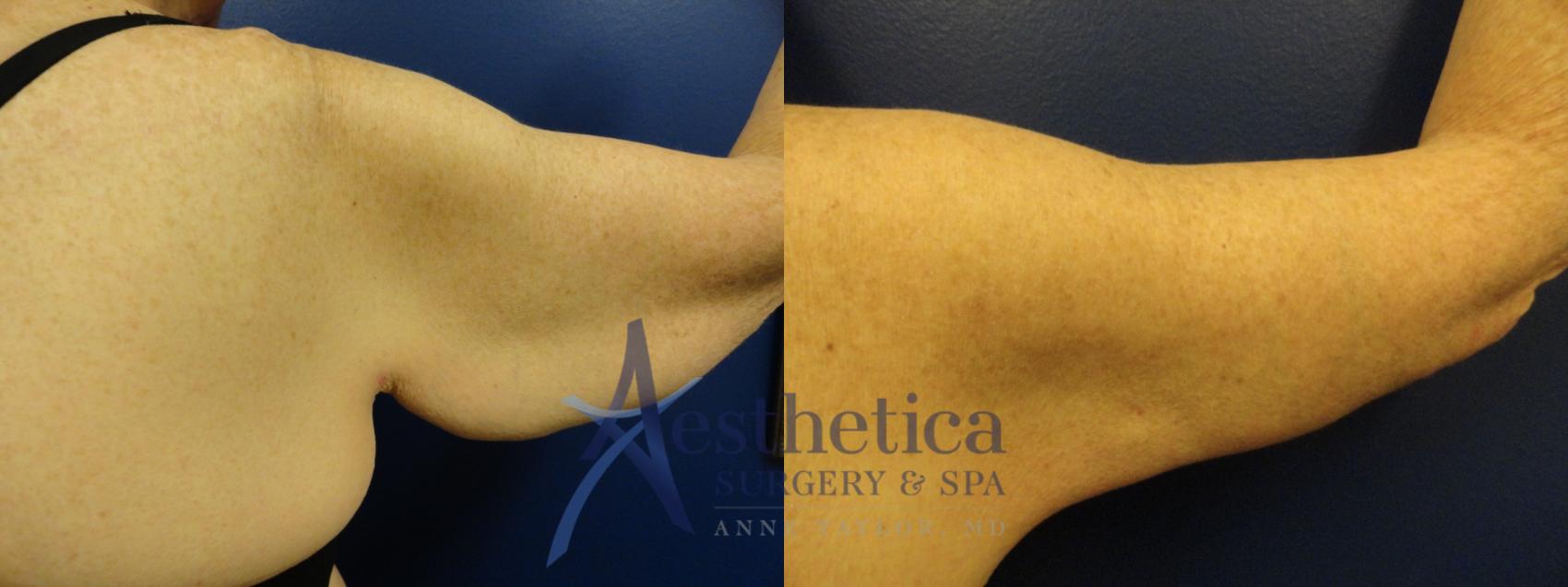 Brachioplasty Case 51 Before & After View #1 | Columbus, OH | Aesthetica Surgery & Spa