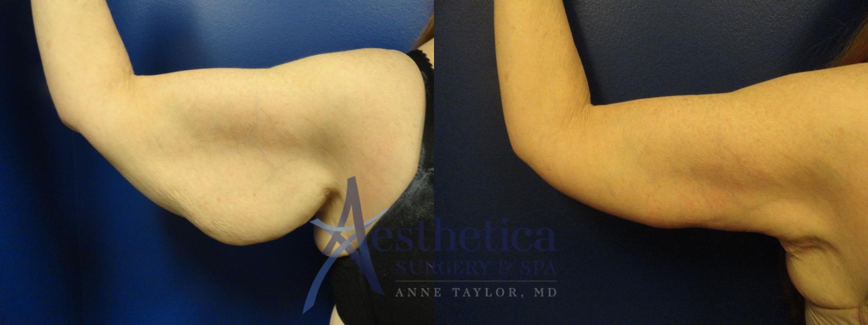 Brachioplasty Case 51 Before & After View #2 | Columbus, OH | Aesthetica Surgery & Spa