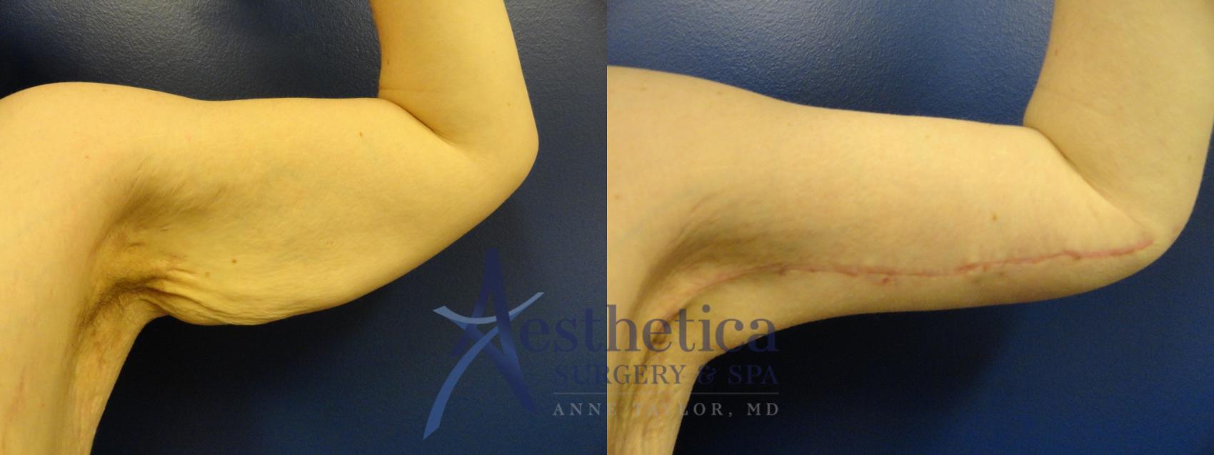 Brachioplasty Case 76 Before & After View #1 | Columbus, OH | Aesthetica Surgery & Spa