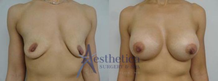 Breast Augmentation Case 10 Before & After View #1 | Columbus, OH | Aesthetica Surgery & Spa