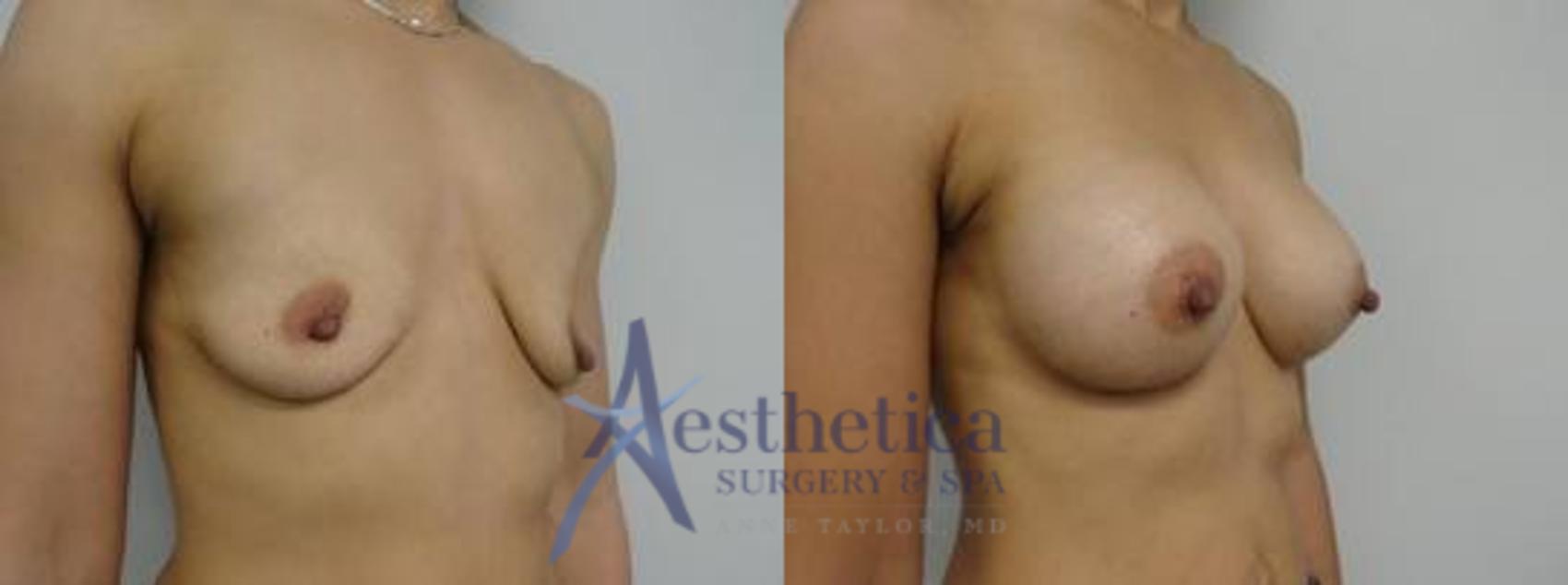 Breast Augmentation Case 10 Before & After View #2 | Worthington, OH | Aesthetica Surgery & Spa