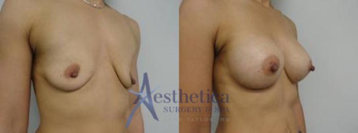 Breast Augmentation Case 10 Before & After View #2 | Columbus, OH | Aesthetica Surgery & Spa