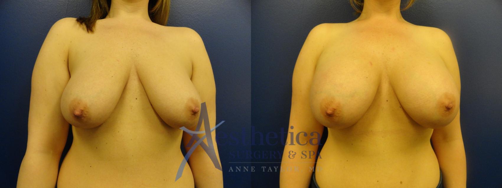 Breast Augmentation Case 108 Before & After View #1 | Columbus, OH | Aesthetica Surgery & Spa