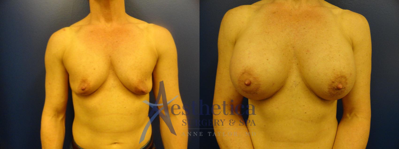 Breast Augmentation Case 110 Before & After View #1 | Columbus, OH | Aesthetica Surgery & Spa