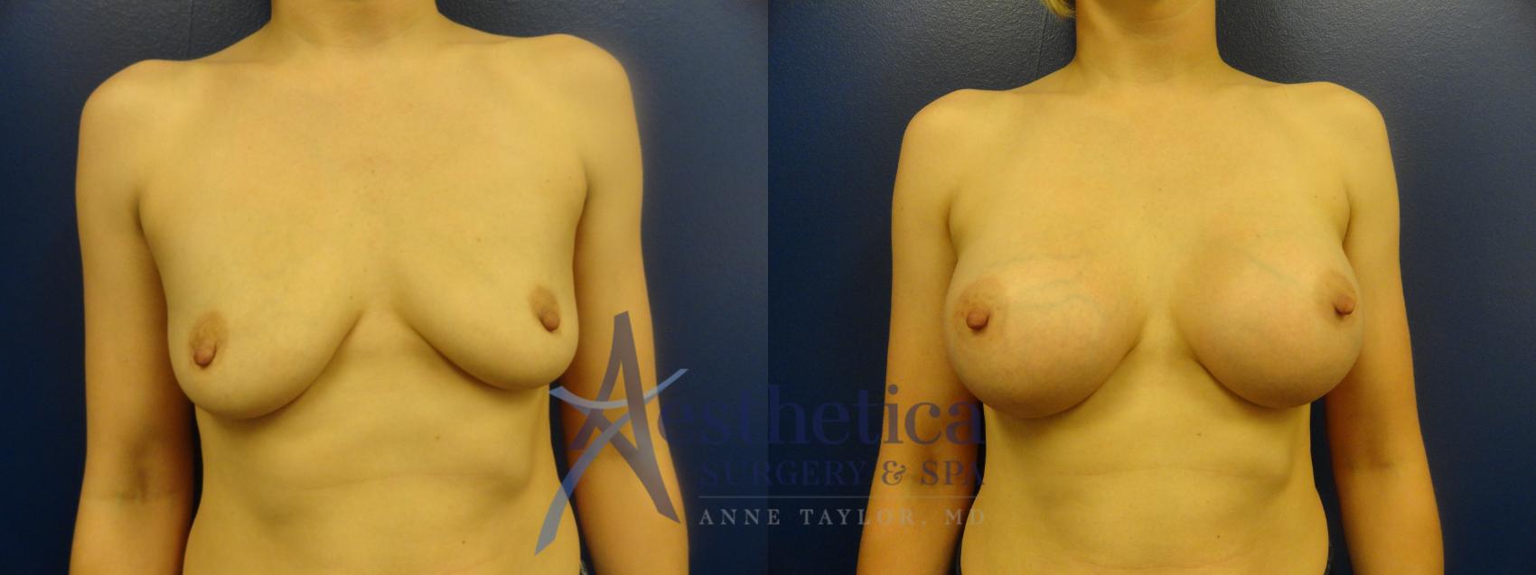Breast Augmentation Case 112 Before & After View #1 | Columbus, OH | Aesthetica Surgery & Spa