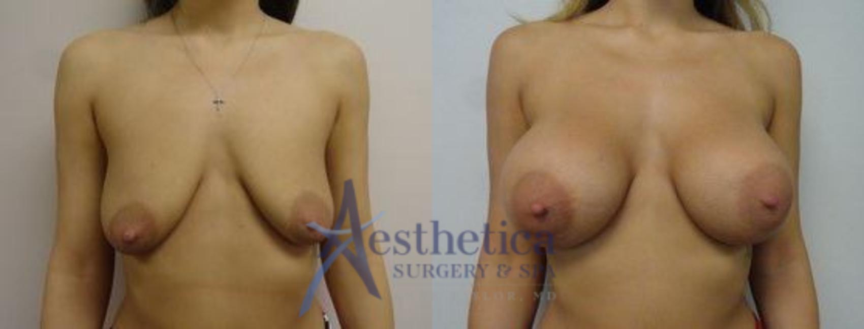 Breast Augmentation Case 12 Before & After View #1 | Columbus, OH | Aesthetica Surgery & Spa
