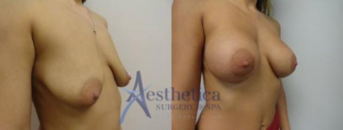 Breast Augmentation Case 12 Before & After View #2 | Columbus, OH | Aesthetica Surgery & Spa