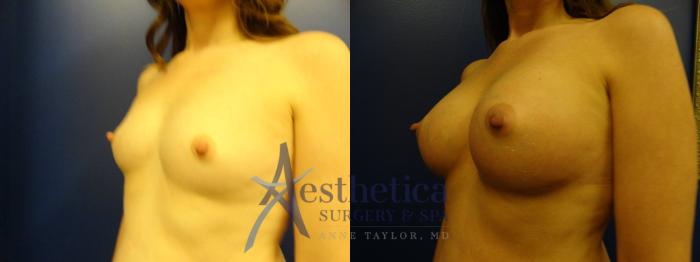 Breast Augmentation Case 131 Before & After View #2 | Columbus, OH | Aesthetica Surgery & Spa