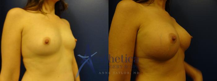 Breast Augmentation Case 131 Before & After View #3 | Columbus, OH | Aesthetica Surgery & Spa