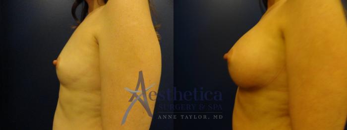 Breast Augmentation Case 131 Before & After View #4 | Columbus, OH | Aesthetica Surgery & Spa