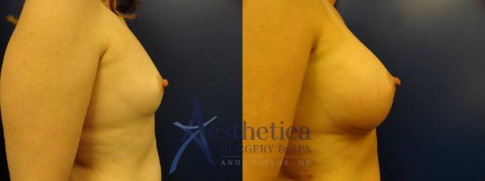 Breast Augmentation Case 131 Before & After View #5 | Columbus, OH | Aesthetica Surgery & Spa