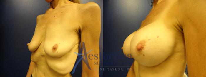 Breast Augmentation Case 133 Before & After View #2 | Columbus, OH | Aesthetica Surgery & Spa