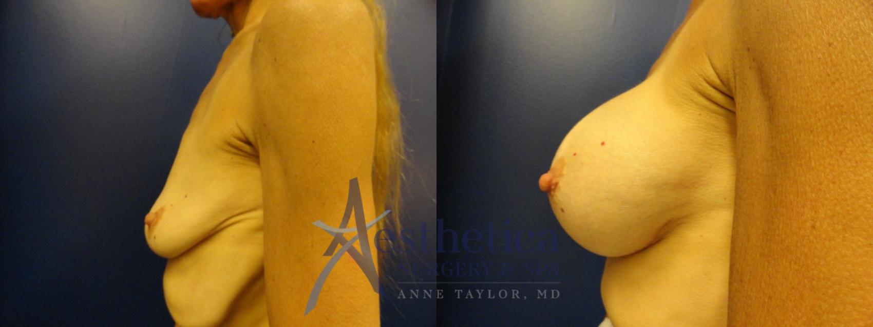 Breast Augmentation Case 133 Before & After View #3 | Columbus, OH | Aesthetica Surgery & Spa