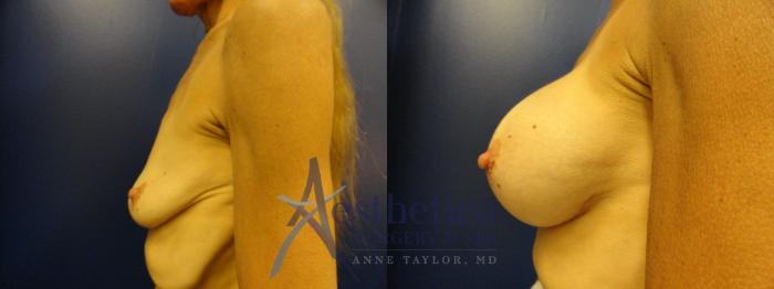 Breast Augmentation Case 133 Before & After View #3 | Columbus, OH | Aesthetica Surgery & Spa