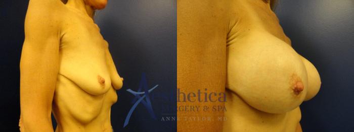 Breast Augmentation Case 133 Before & After View #4 | Columbus, OH | Aesthetica Surgery & Spa