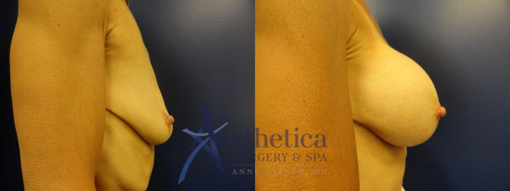 Breast Augmentation Case 133 Before & After View #5 | Columbus, OH | Aesthetica Surgery & Spa