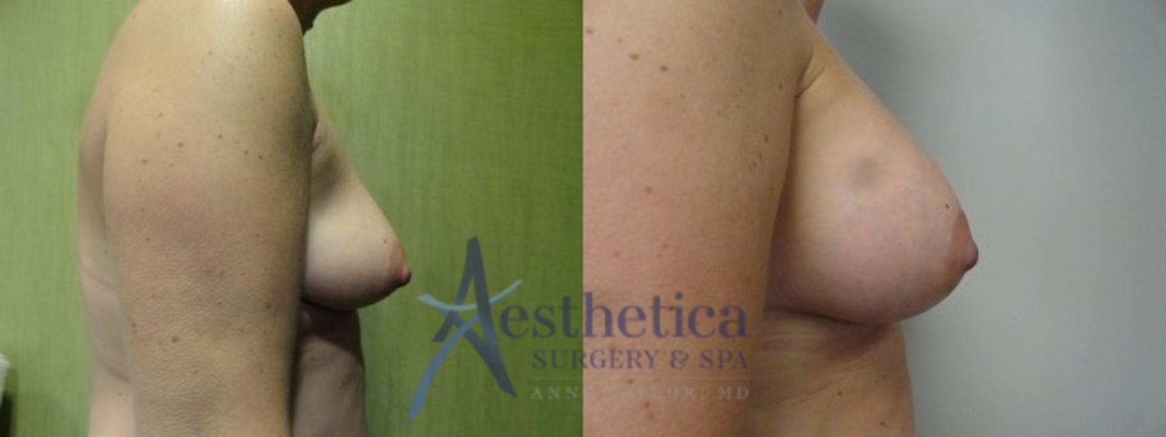 Breast Augmentation Case 15 Before & After View #1 | Columbus, OH | Aesthetica Surgery & Spa