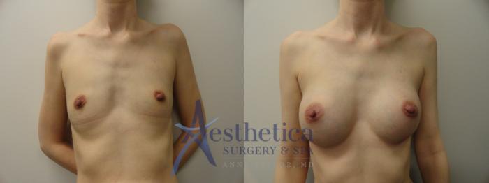 Breast Augmentation Case 166 Before & After View #1 | Columbus, OH | Aesthetica Surgery & Spa