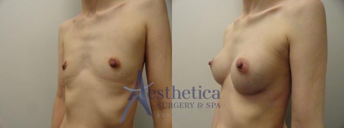 Breast Augmentation Case 166 Before & After View #2 | Columbus, OH | Aesthetica Surgery & Spa