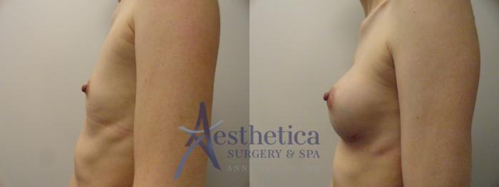 Breast Augmentation Case 166 Before & After View #3 | Columbus, OH | Aesthetica Surgery & Spa