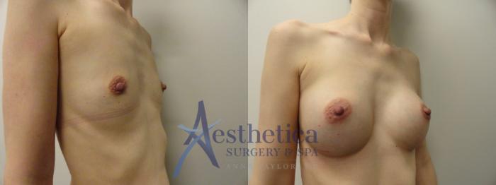 Breast Augmentation Case 166 Before & After View #4 | Columbus, OH | Aesthetica Surgery & Spa