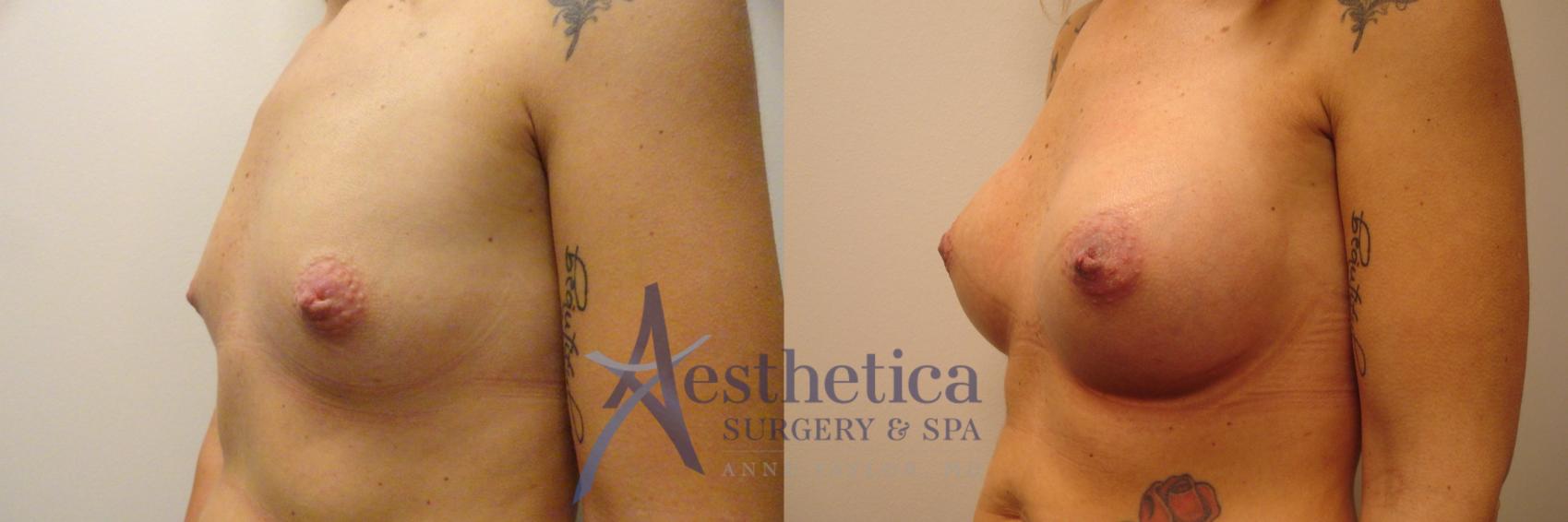 Breast Augmentation Case 172 Before & After View #2 | Columbus, OH | Aesthetica Surgery & Spa