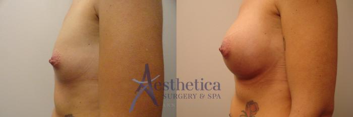 Breast Augmentation Case 172 Before & After View #3 | Columbus, OH | Aesthetica Surgery & Spa