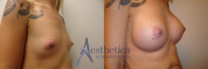 Breast Augmentation Case 172 Before & After View #4 | Columbus, OH | Aesthetica Surgery & Spa