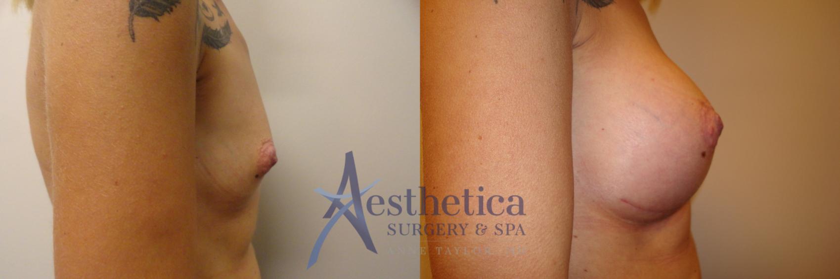 Breast Augmentation Case 172 Before & After View #5 | Columbus, OH | Aesthetica Surgery & Spa