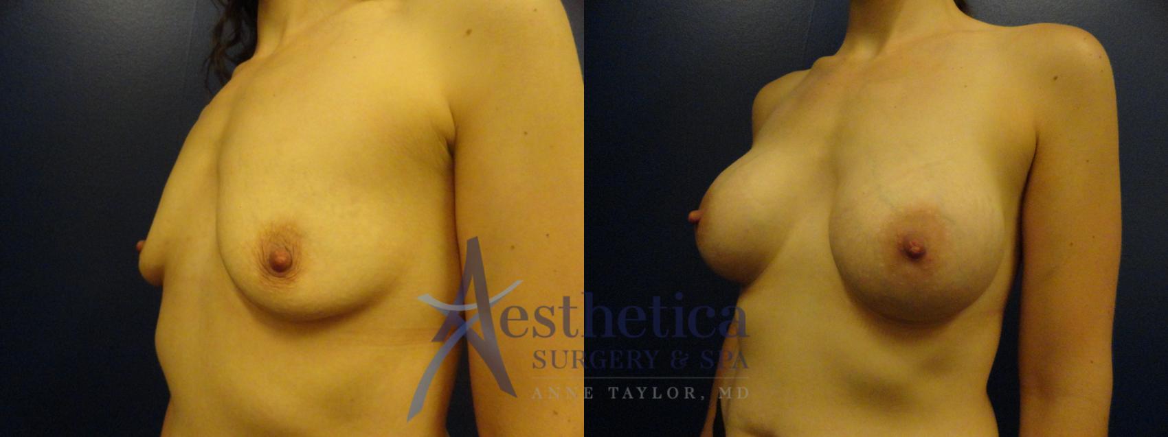 Breast Augmentation Case 182 Before & After View #2 | Worthington, OH | Aesthetica Surgery & Spa