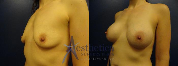 Breast Augmentation Case 182 Before & After View #2 | Columbus, OH | Aesthetica Surgery & Spa